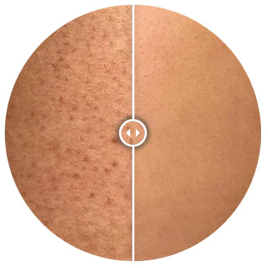 Permanent Hair Removal van Lusuna