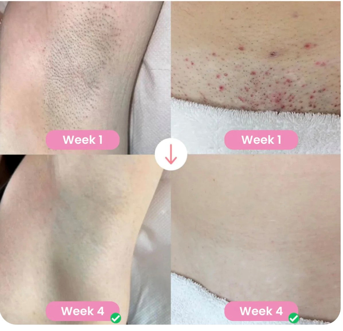 Permanent Hair Removal van Lusuna